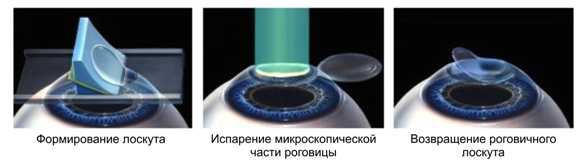 laser3